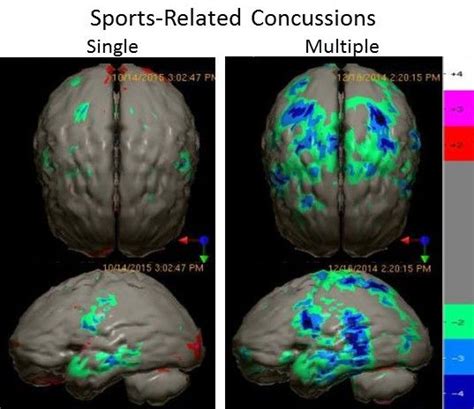 are we taking concussions too seriously psychology today