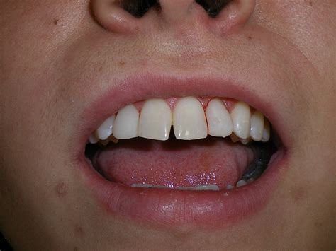 cavities    front teeth teethwalls