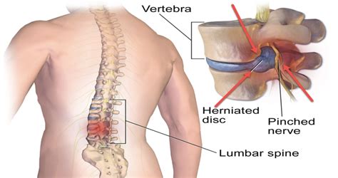 Is It A Herniated Disc A Bulging Disc Or A Pinched Nerve