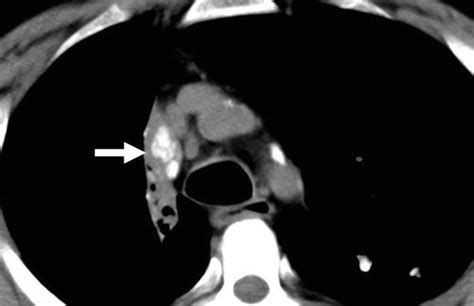 Lymph Node Calcification Axial Ct Shows Right Paratracheal Calcified