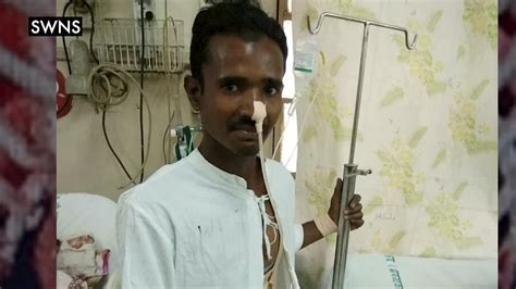 Man Impaled By A 4 Foot Pole Through His Groin Is Saved By Doctors