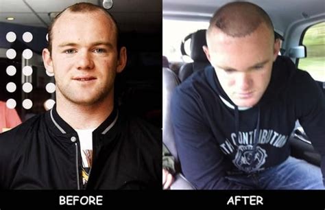 Wayne Rooney Hair Transplant Before And After Hairline Wayne Rooney