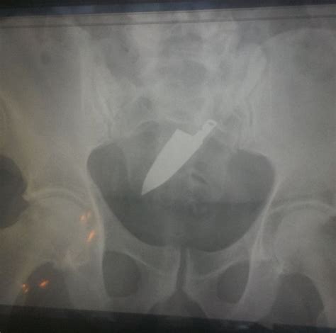 11 Weird Things Doctors Have Found Stuck In People S Butts Huffpost Uk