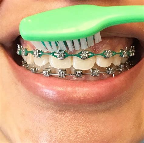 pin on dental braces