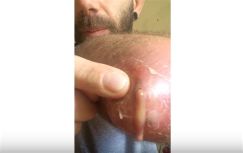 elbow bursitis treatment new pimple popping videos