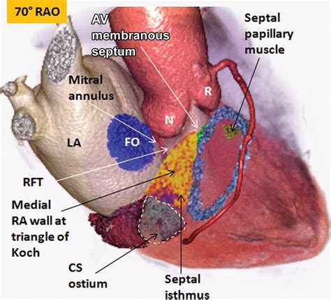 septal atrioventricular junction region comprehensive imaging
