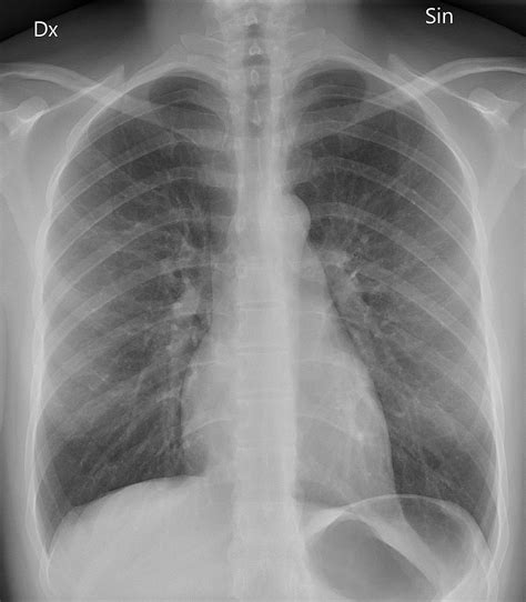 chest radiograph wikipedia