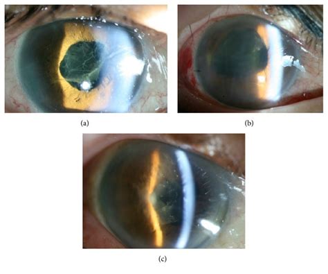 백내장 수술 안과수술 후 발생한 독성 전방 증후군 Toxic Anterior Segment