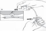 Tracheostomy Suction When sketch template
