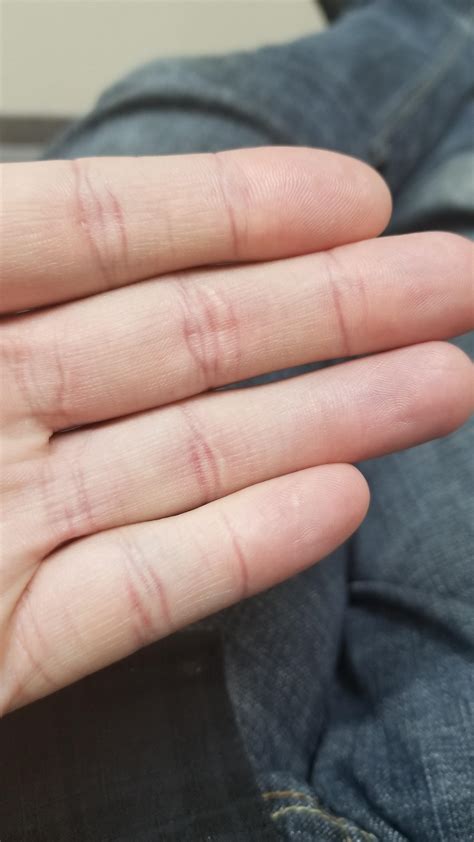 finger crease disappeared    months  knuckle  working rmildlyinteresting