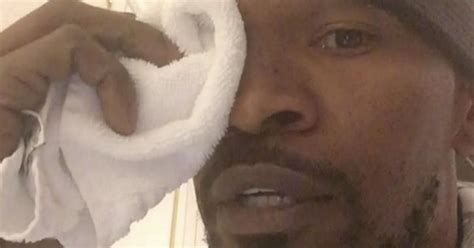 jamie foxx jokingly nurses swollen eye while playing down claim he