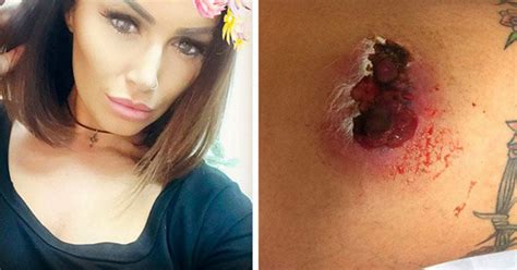 Porn Star Gemma Massey Left With Gaping Hole In Leg After