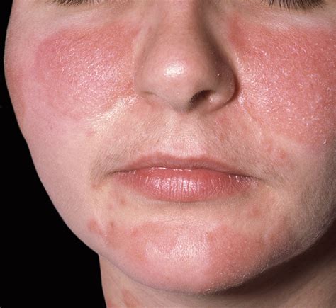 mask related acne maskne   facial dermatoses  bmj