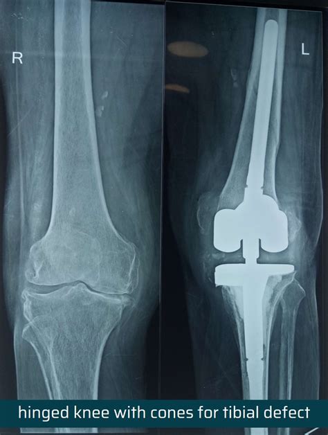revision total knee replacement surgery ahmedabad dr rachit sheth