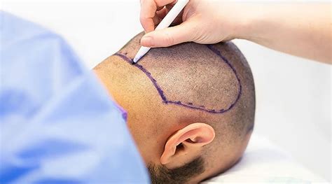 donor area heal  hair transplantation