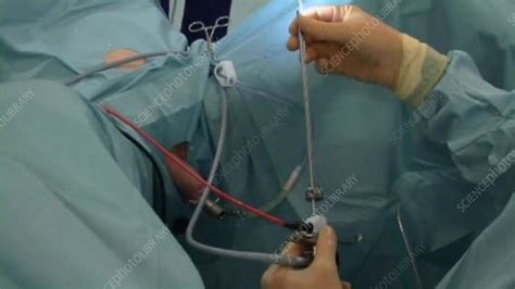 Bladder Evacuation During A Turp Biopsy Stock Video Clip K003 8586