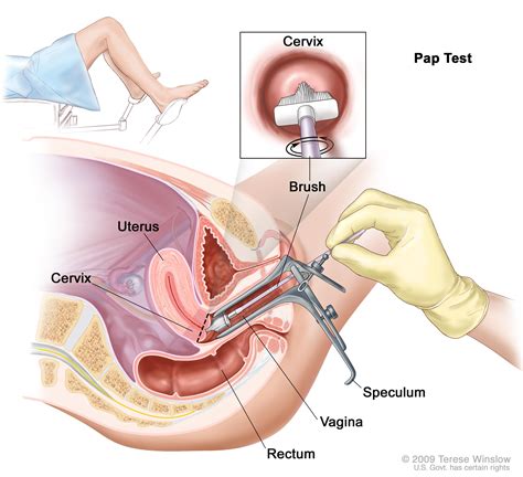 vaginal cancer treatment pdq® patient version national cancer institute