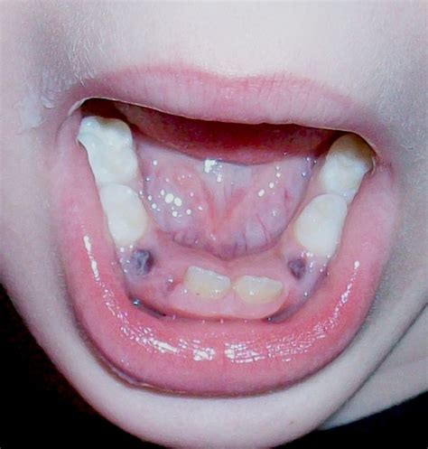 young child  teeth pulled patients lounge
