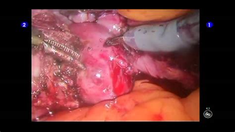 davinci robotic prolapsed fallopian tube removal andrew croak do youtube