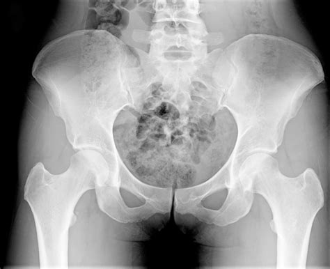 hip fracture buyxraysonline