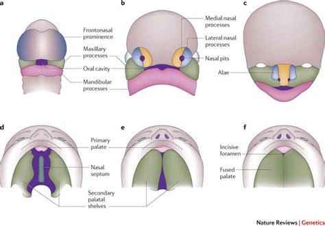 Figure 1 Cleft Lip And Palate Understanding Genetic And