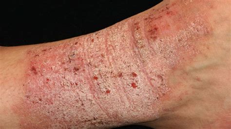 eczema dermatology conditions  treatments