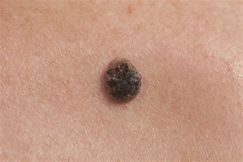 10 Deadly Signs Of Skin Cancer You Need To Spot Early – Page 6 – Health