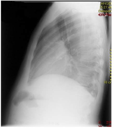 Chest X Ray Lateral View Re Accumulation Of Massive Open I