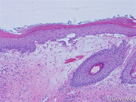 lichen sclerosus of penis