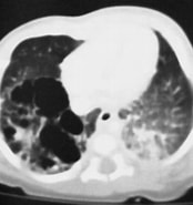 Image result for Zystisch adenomatoide malformation der Lunge. Size: 174 x 185. Source: www.kidsdoc.at