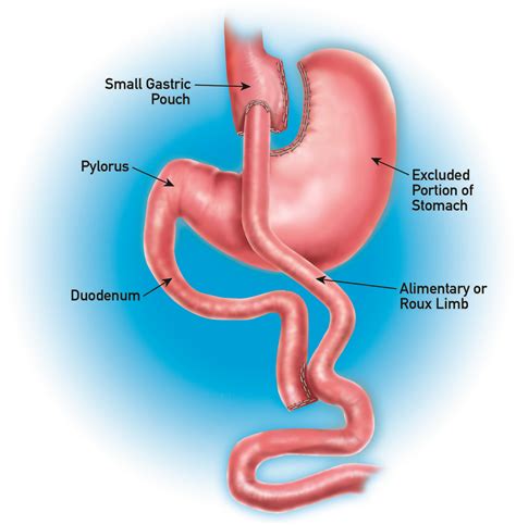 Gastric Bypass Rny Weight Loss Surgery In Dallas And Plano