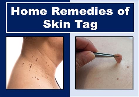 effective methods to remove skin tags health kura