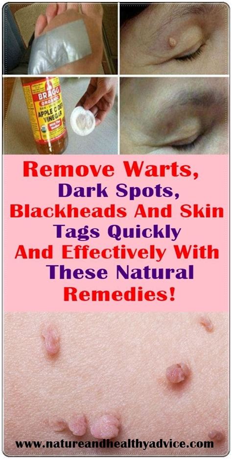 pin on warts on face