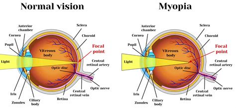 myopia nearsighted vision  signs symptoms treatment