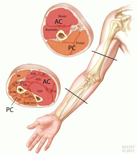 surgical decompression  acute compartment syndrome   arm  forearm musculoskeletal key