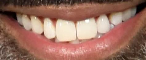 donnell turner teeth pictures