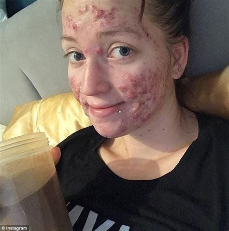 manitoba woman shares her battle against severe acne