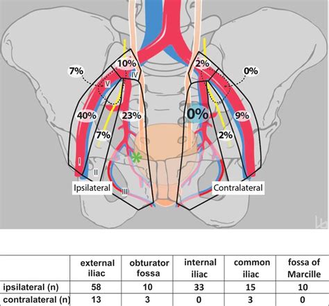 Pelvic Lymph Node Dissection May Be Limited On The Contralateral Side