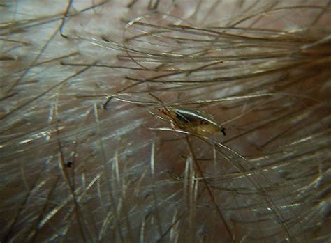 Parassiti ben poco leggendari sui quali, tuttavia, spopolano i falsi miti. Pidocchi in un bambino (foto dettagliate di infettare i bambini) e cosa