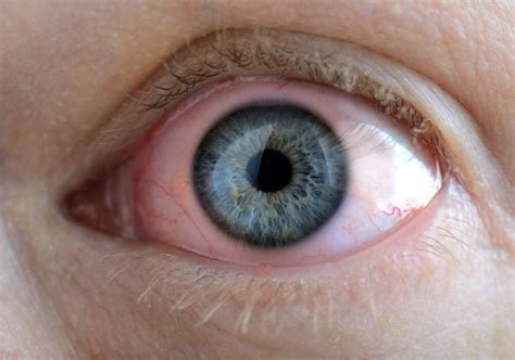 What Are Gonococcal And Chlamydial Conjunctivitis