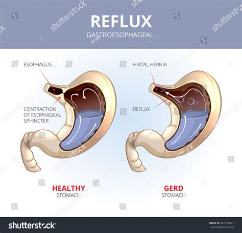 gastroesophageal reflux disease stock photo  shutterstock