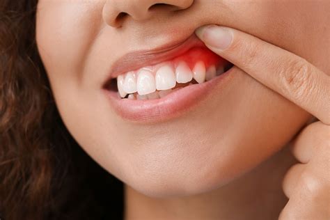 understanding  stages  gum disease metro smiles dental forest