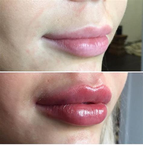 qandas for lip fillers lip injections dr ricky best cosmetic clinic