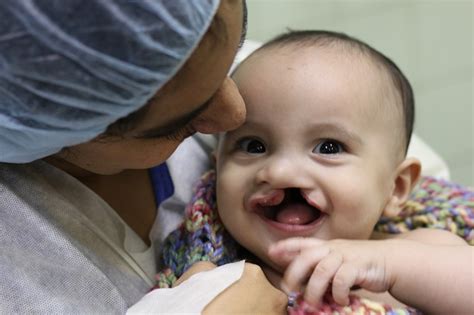 cleft faces foundation