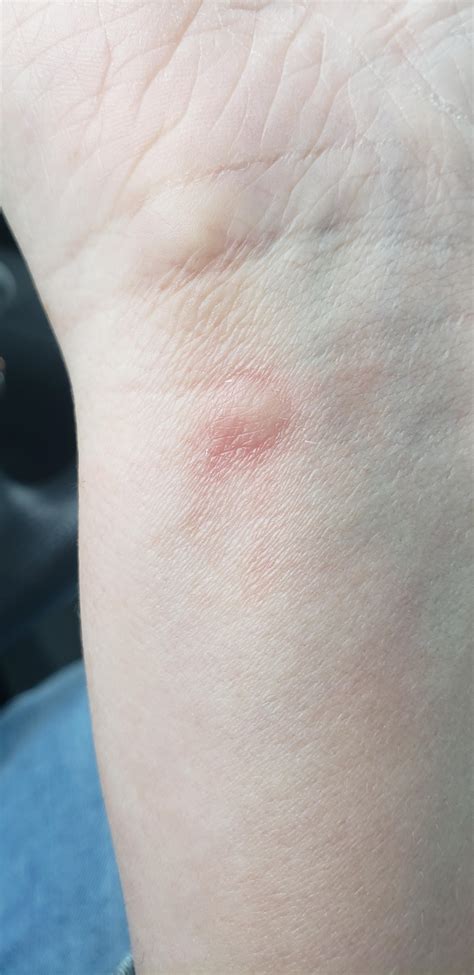 itchy red bump  wrist noticed  yesterday spot   covered   smart