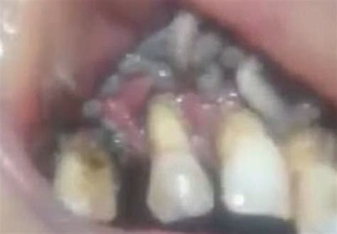 graphic video shows dentist patients mouth filled  hundreds   maggots
