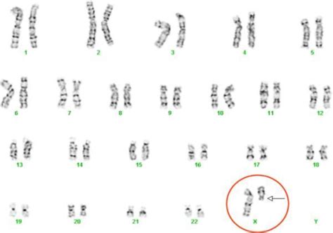 Karyotype Of Turners Syndrome Sle Subject Demonstratin Open I