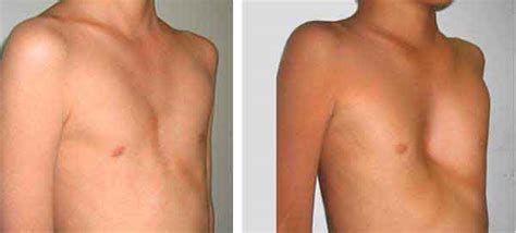 what is pectus excavatum how to fix it in 2019 and more