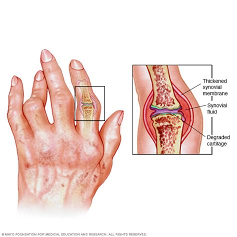 rheumatoid arthritis disease reference guide