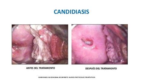 Candidiasis Naturopathic